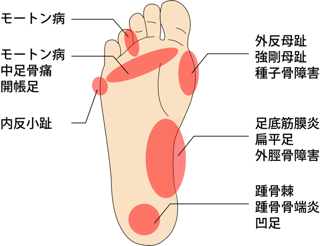 かかと の しびれ 原因 片足